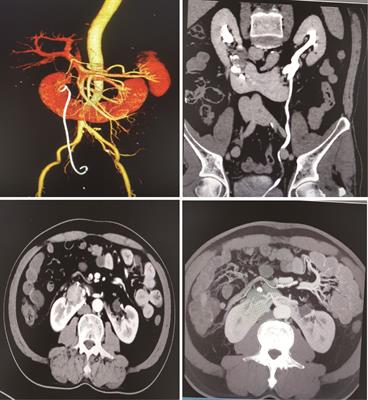 Pure laparoscopic radical nephroureterectomy for complicated renal pelvis carcinoma combined with horseshoe kidney: A case report and literature review